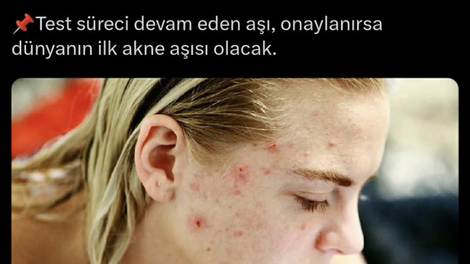 Sivilce aşısı olur musunuz?