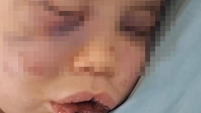 Denizli’de 2 Yaşındaki Bebek Dövülerek Hastanelik Edildi! Nasıl bir vicdan, bir bebeğe bunu yapabilir?