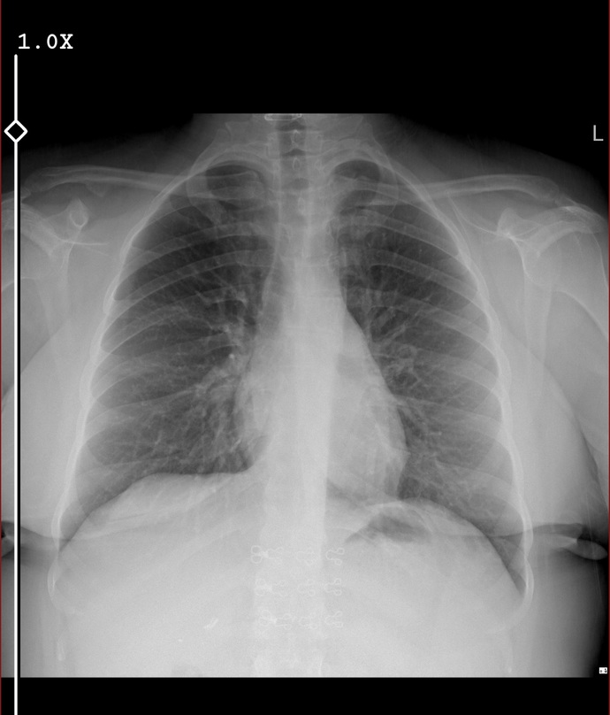 Akciger röntgeninden anlayanlar foto bırakıyorum bakar mısınız doktorların bazıları temiz diyor bazıları beyazlık var diyor?