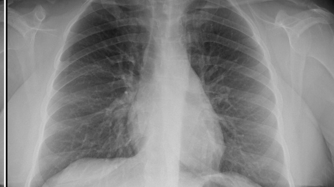Akciger röntgeninden anlayanlar foto bırakıyorum bakar mısınız doktorların bazıları temiz diyor bazıları beyazlık var diyor?