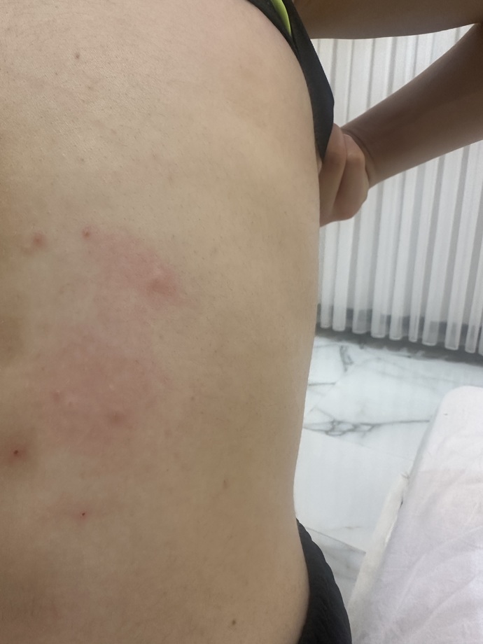 Sırtımdakiler böcek sinek ısıriği mi sivilce mi?