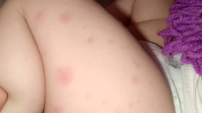Bu alerjinin daha hızlı geçmesi için ne yapabilirim?