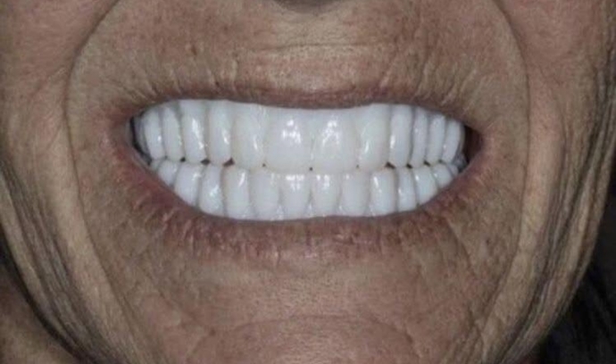 Dişlerimi yeni yaptırdım nasıl olmuş?🤔 sizce rengini bi tık daha mı koyu yaptırsaydım yoksa bu renk tenime uygun mu?🤔?