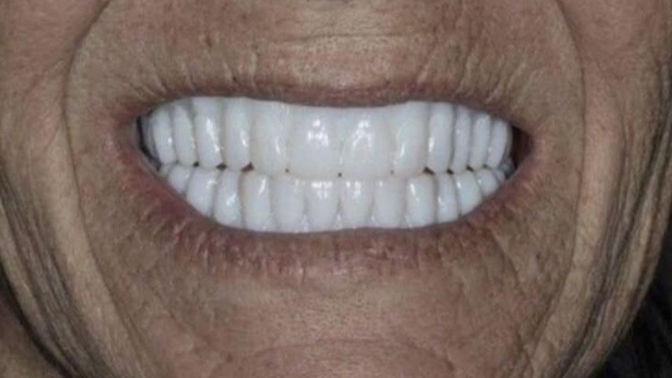 Dişlerimi yeni yaptırdım nasıl olmuş?🤔 sizce rengini bi tık daha mı koyu yaptırsaydım yoksa bu renk tenime uygun mu?🤔?