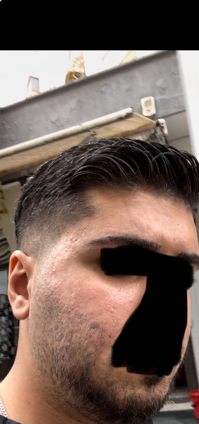Sivilce izlerim var ne derece kötü duruyor özgüvenimi çok zedeliyor?