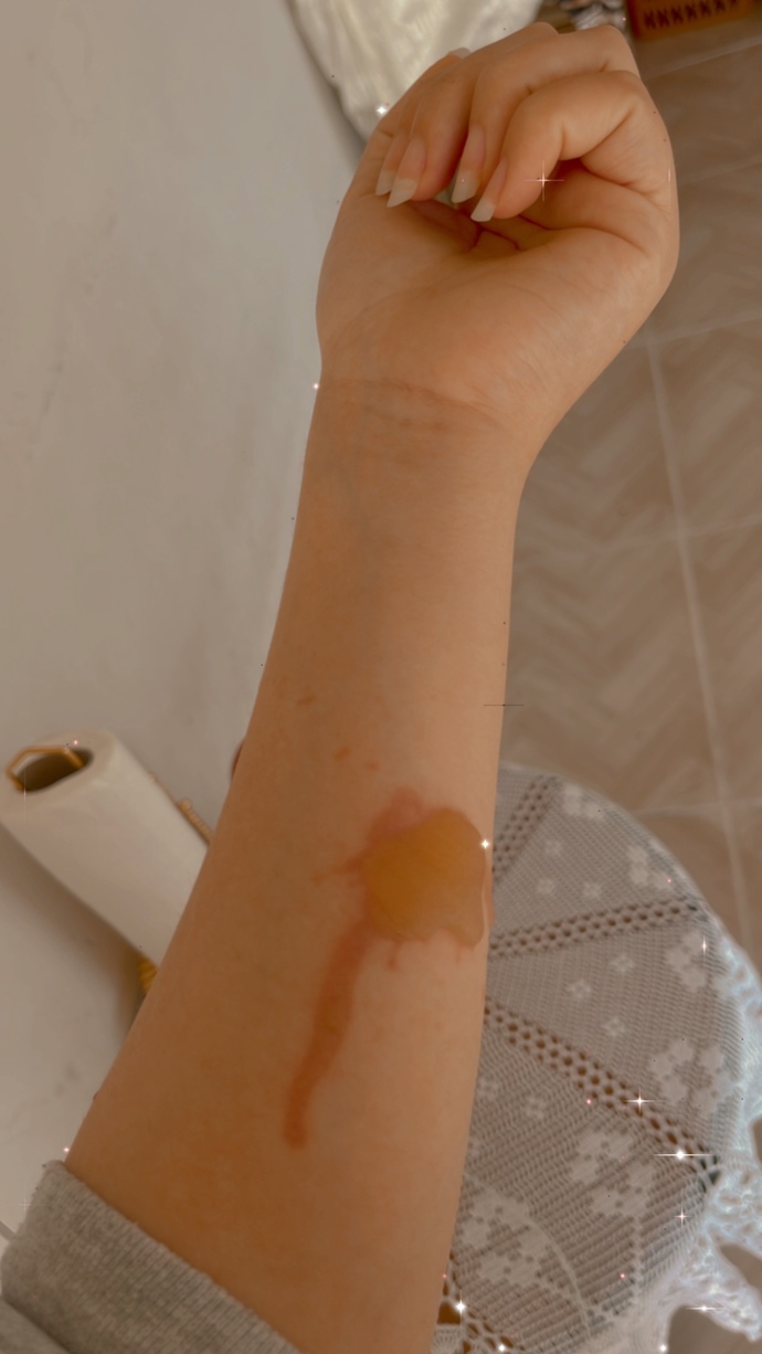 Kızlarrr patates kızartırken yağ sıçradı koluma böyle kızardı ve baloncuk oldu. iz kalmaması için ne önerirsinizzz?