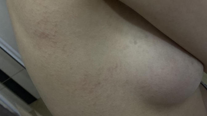 Bugün vücudumda bunları fark ettim ve kaşınıyor, sebebi ne olabilir? Detayı okur musunuz?