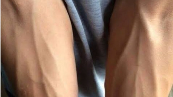 Kol damarlarım neden farklı?
