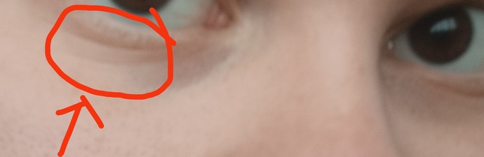 Yaşım 19 olmasına rağmen bu yaşında göz altında kırışıklıklar var?