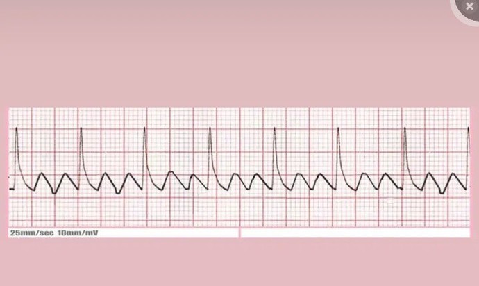 Bu EKG ritmini okuyabilen var mı?