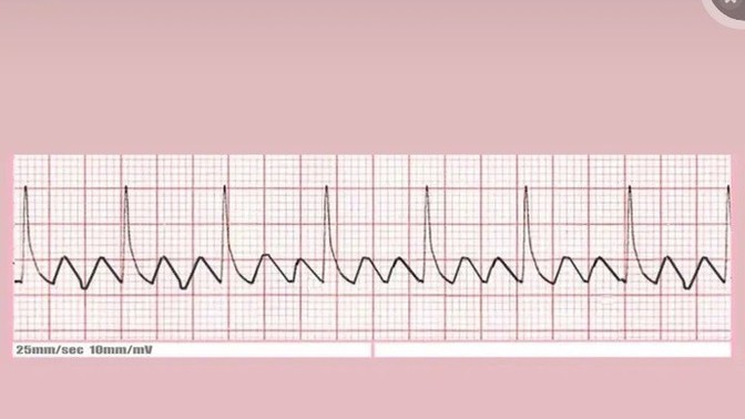 Bu EKG ritmini okuyabilen var mı?