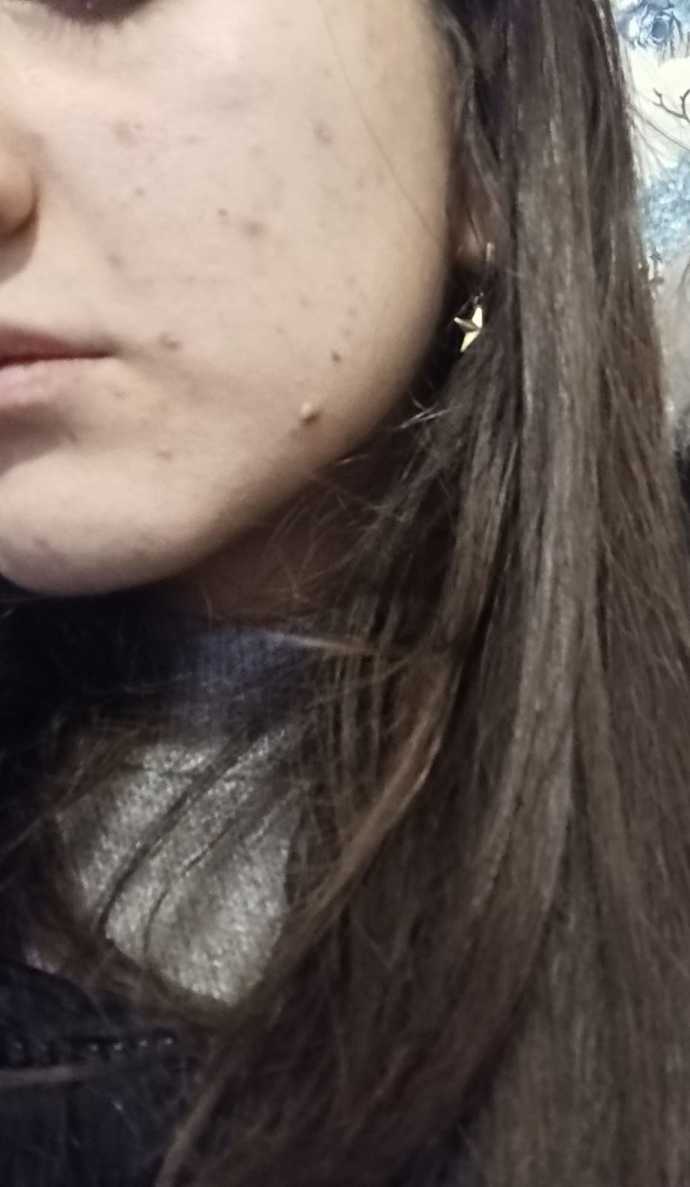 Nasil sizce sivilce lekelerimde azalma var mı üsteki fotograf ilk hali alttaki simdiki hali 😊?