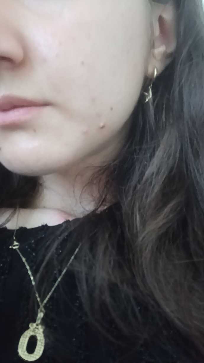 Nasil sizce sivilce lekelerimde azalma var mı üsteki fotograf ilk hali alttaki simdiki hali 😊?