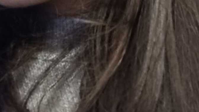 Nasil sizce sivilce lekelerimde azalma var mı üsteki fotograf ilk hali alttaki simdiki hali 😊?