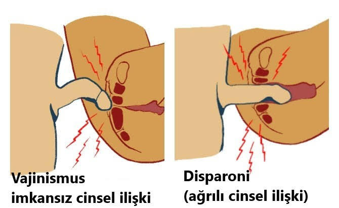 İlişkide vajinamın içinde bir duvar varmış gibi hissediyorum neden?