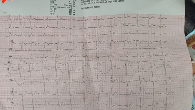Acilde göğsüm ağrıyor diye EKG istediler bir karfiyolojiye görünebilirsin dedi?