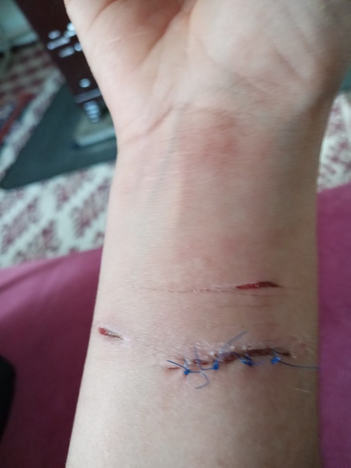 Bu yara açık bir şekilde enfeksiyon kapar mi?