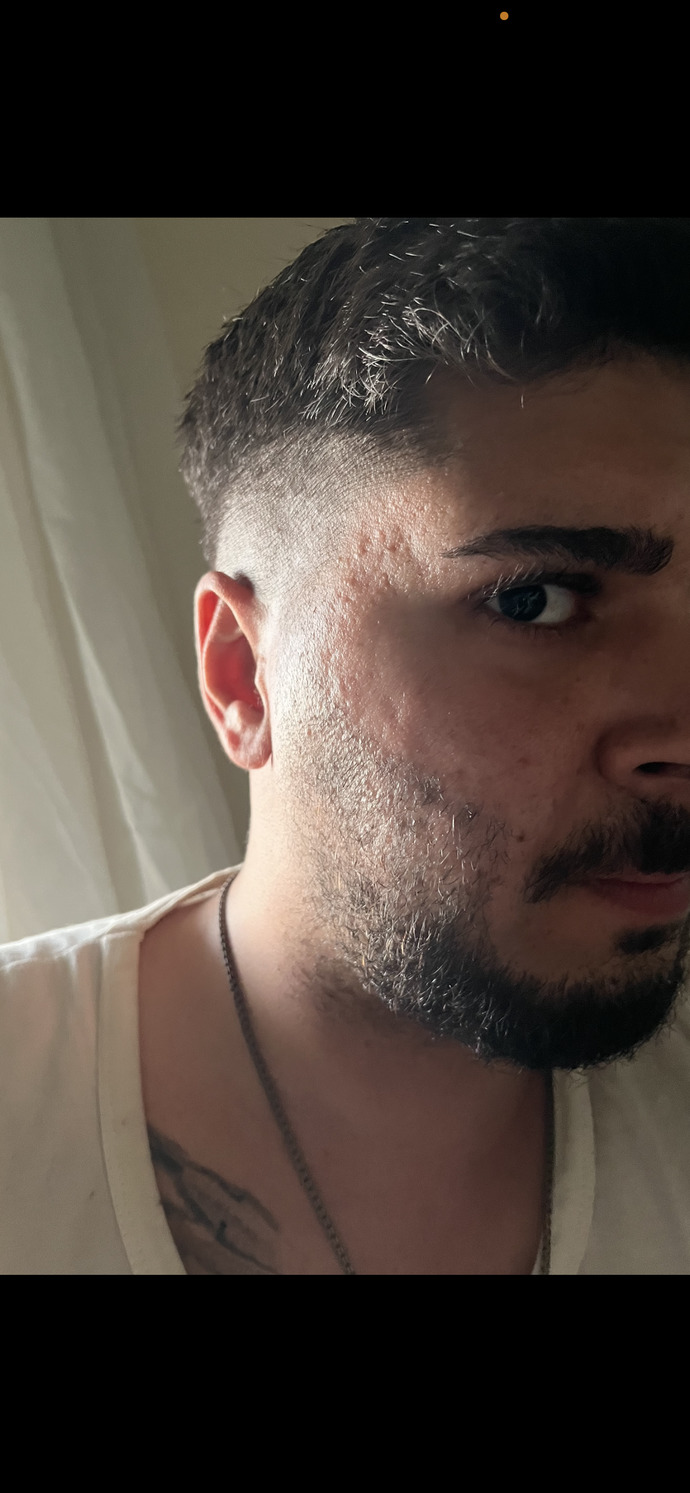 Kızlar, Sivilce izlerim çok mu kötü gözüküyor cildi böyle olan biri ile sevgili olur muydunuz?