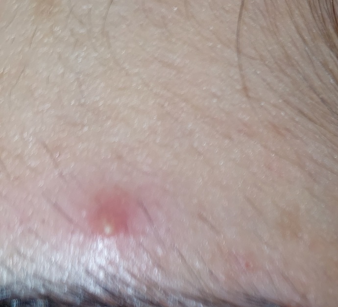 Bu sivilceler nasıl kurur?