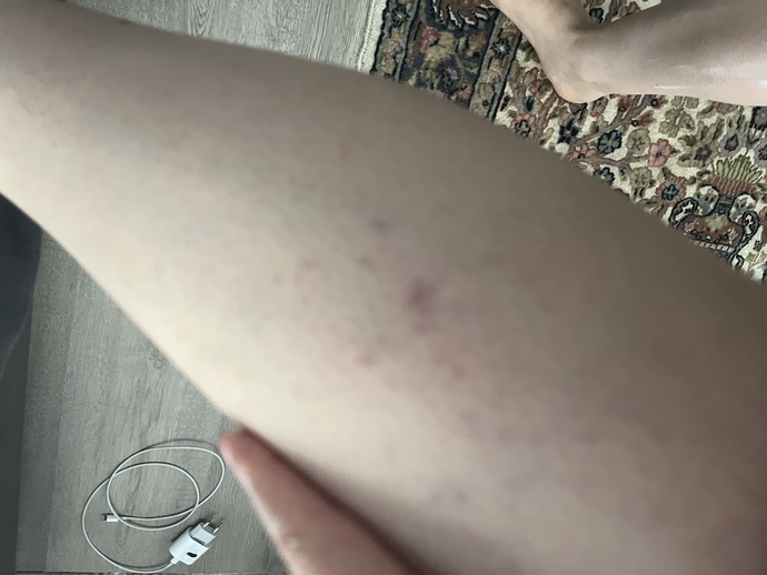 Bacaklarıma ilk defa ağda yaptım ve böyle oldu, neden?