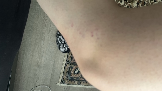 Bacaklarıma ilk defa ağda yaptım ve böyle oldu, neden?