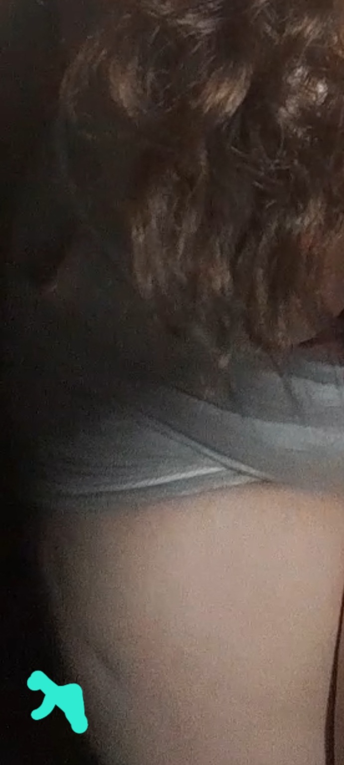 Bacagimda boyle bir cukur var bu neden olur?