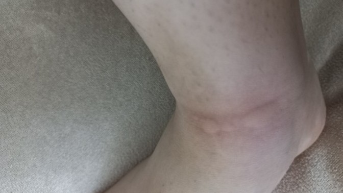 Benim ayağımda böyle bir şey oluştu sizce ne olabilir?