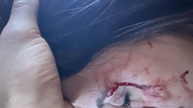 Kaşım böyle patladı sizce dikişe gerek var mı kaş çıkmazmı daha?