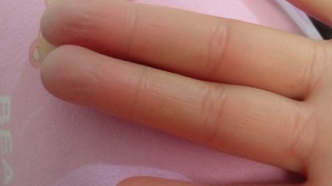 Sizinde parmağınız böyle oluyor mu?