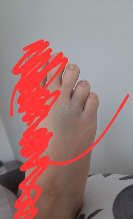 Arkadaşlar dün ayagımi hatta parmağımı sehbaya vurdum ve sonra cok agrıdı şu an bu şekilde agrısı yok ama basamıyorum kırık mıdır?