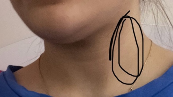 Boynumun bu işaretlediğim kısmında özellikle akşamları diş ağrısı gibi ağrı oluyor 4-5 gündür. sizce nedendir ya?