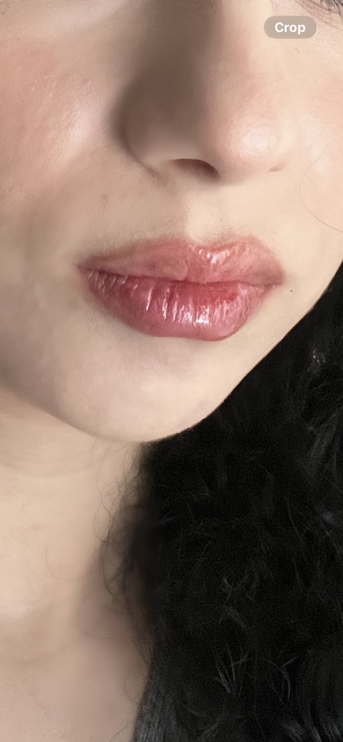 Dudağıma dolgu yaptırdım biraz çok fark olmuş mu?