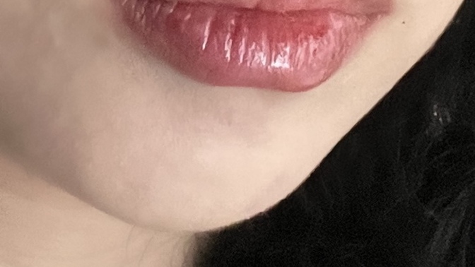 Dudağıma dolgu yaptırdım biraz çok fark olmuş mu?