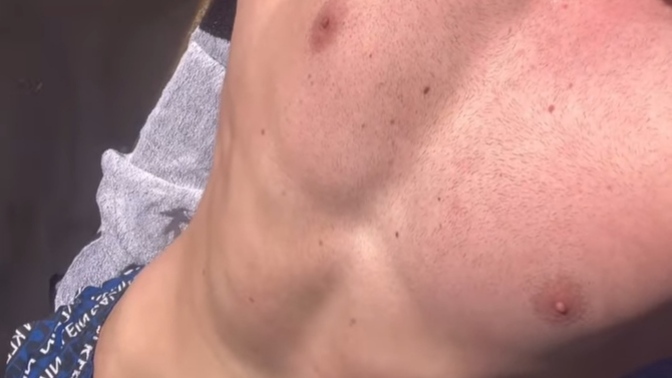Güneşte tatilde yanmak iyi mi?