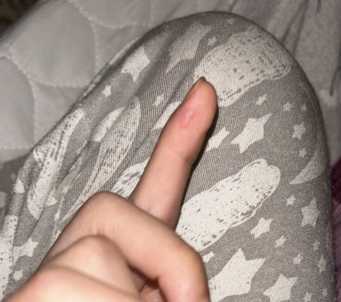 yaktıktan bikaç saat sonra fark ettim tam yatmak üzereyken, su toplamış dokununca acıyor. napmam lazim iz falan kalır mı?
