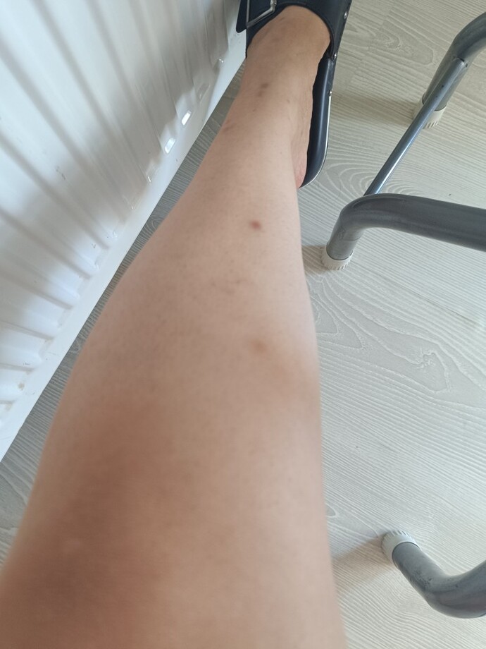 Bu böcek ısırık izlerine ne iyi gelir bilen var mı ya?