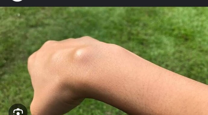 Heryerde kist ve kanser deniyor da bunu daha önce aranizda yaşamış biri var mı?