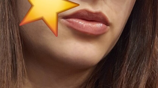 Dudak dolgusu yaptırsam mı?