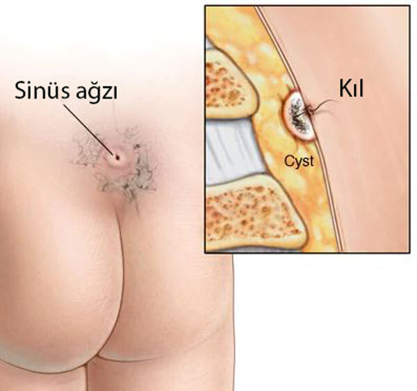 Bu nedir tam olarak, tehlikeli bir sey mi yoksa kil donmesi falan mi?
