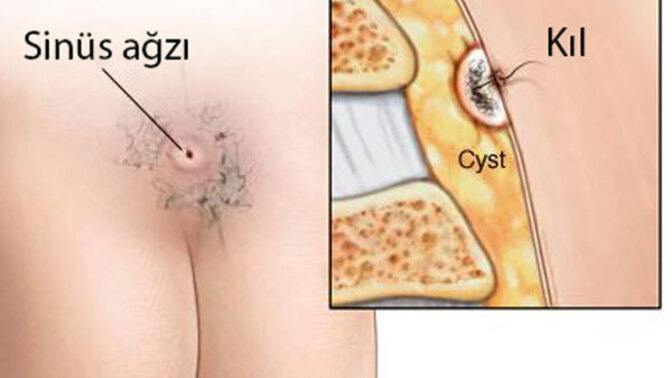 Bu nedir tam olarak, tehlikeli bir sey mi yoksa kil donmesi falan mi?