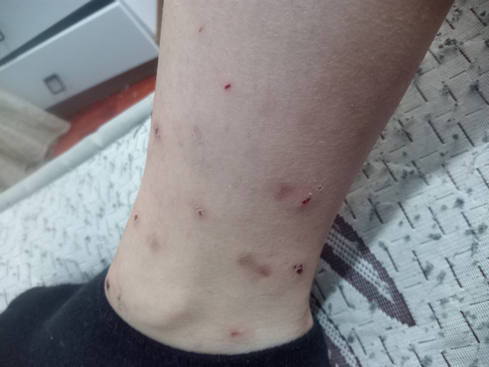 Kaşıntı ve şişme neden olur yardım?