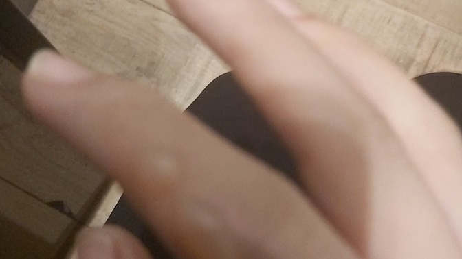Parmağım su topladı ne yapacağım?