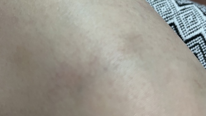 Arkadaşlar bu 1 sene olucak geçmiyor bu ne olabilir beyaz tenliyim kötü duruyor ağrı falan şişlikte yok kan değerleiede normal. ?