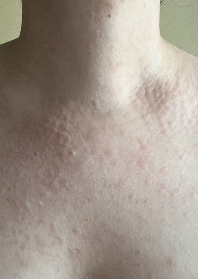Limonlu maske sürdükten sonra cildim böyle oldu ne yapsam gecer?