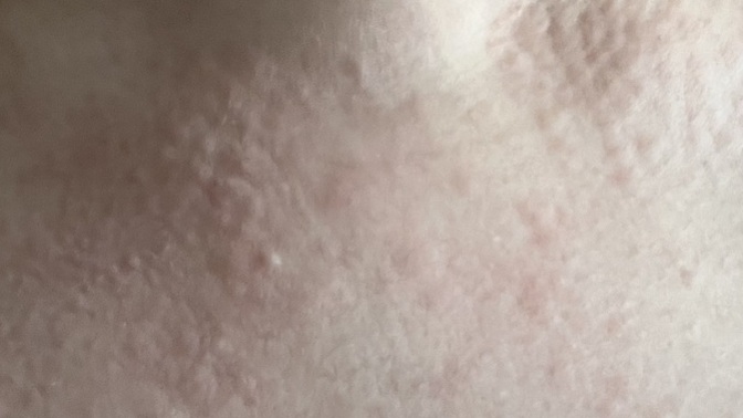 Limonlu maske sürdükten sonra cildim böyle oldu ne yapsam gecer?
