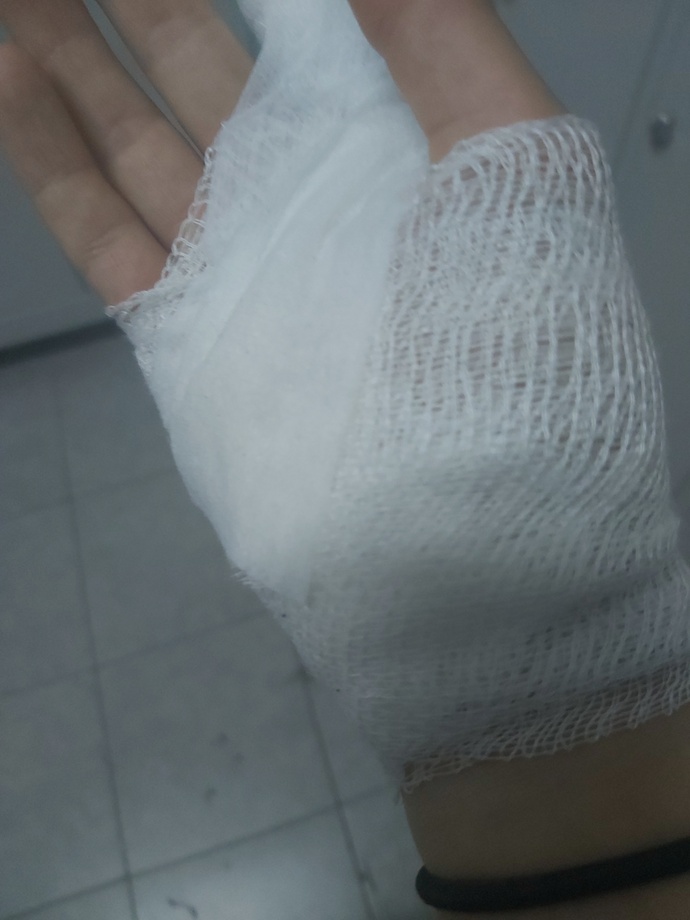 Elimin içi ile sıcak pürmuzün ucunu tuttum elim su toplar mi?