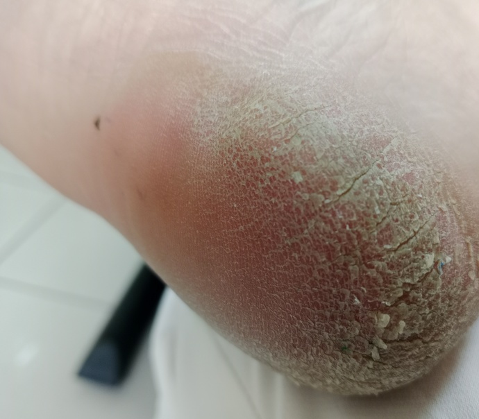 Sandalet giymeye başladığımdan beri topuklarim bu durumda ne önerirsiniz?