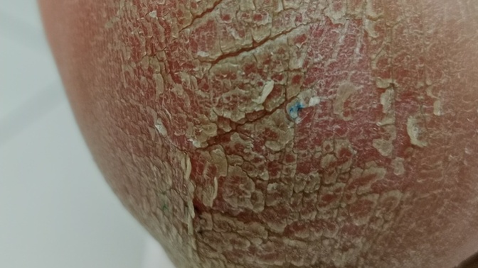 Sandalet giymeye başladığımdan beri topuklarim bu durumda ne önerirsiniz?