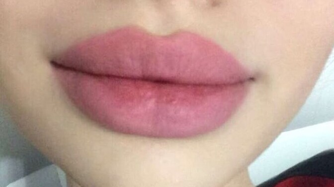 Dolgun dudaklar sadece estetikle mi mümkün?