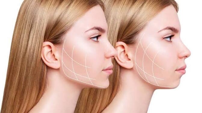 Kadınlara çene dolgusu yakışıyor mu sizce?